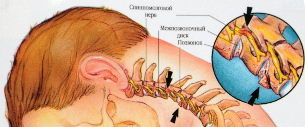 болит шея сзади / почему болит шея сзади